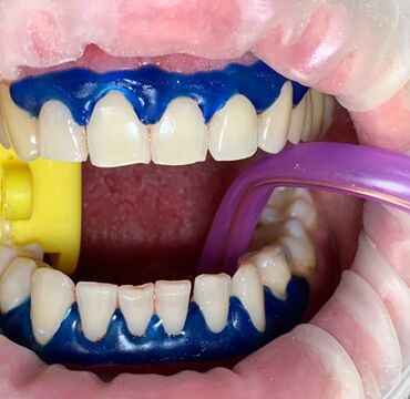 Фото відбілювання лампою Magic Smile // Стомасервіс в Дніпрі