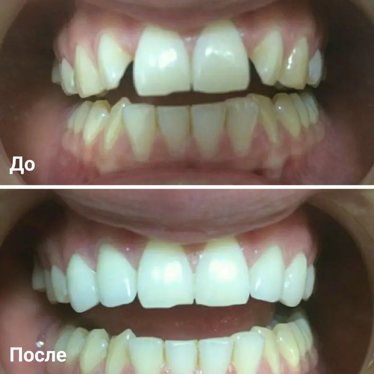 Установка виниров Днепр